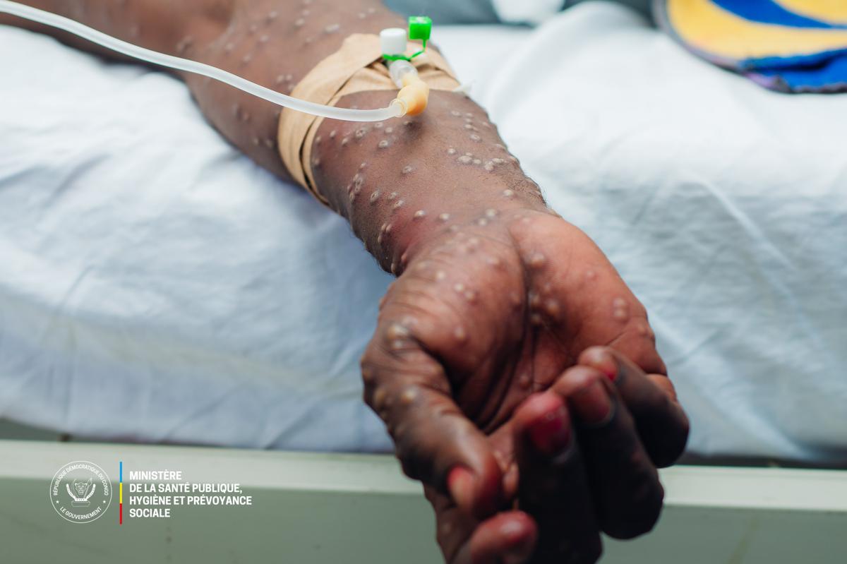 Lees meer over het artikel Provincie Kasaï worstelt met verspreiding Mpox-virus (CongoForum)